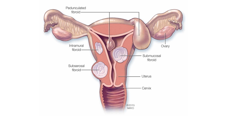 Uterine-Fibroids
