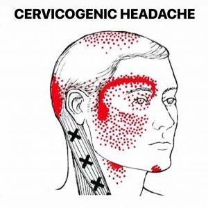 Cervicogenic_Headache