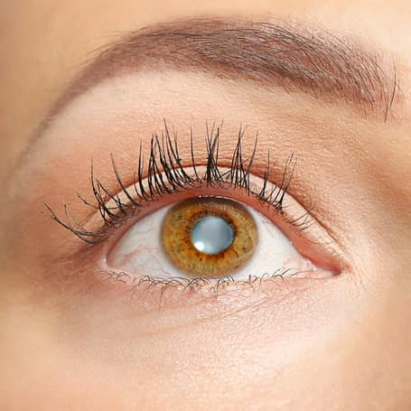 Know About Cataract Surgery Causes Symptoms Treatment Know About Cataract Surgery Causes Symptoms Treatment