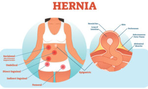 Hernia in Hindi
