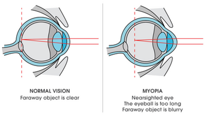 Lasik surgery can correct Myopia