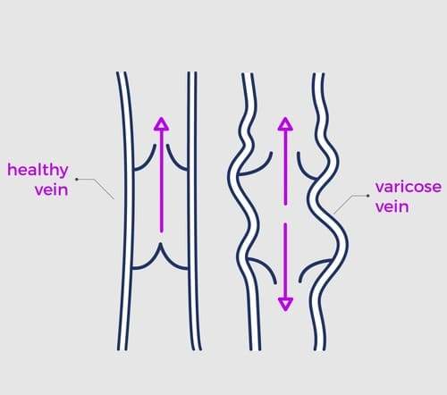 varicose vein treatment