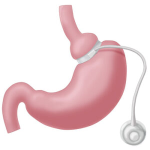 Gastric Banding Surgery works