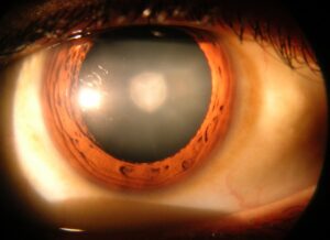 What Is a Stellate Cataract?