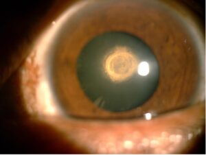 Posterior Polar Cataract (PPC): What It Is and How to Treat It