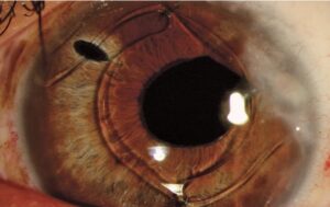 What Does Intraocular Lens Mean?