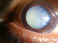 What Is An Intumescent Cataract?