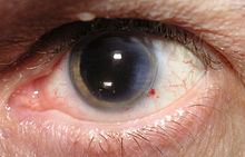 What Is Extracapsular Cataract Extraction?