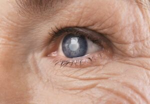 Why Cataract Surgery Precautions Are Important?