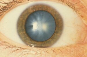 What Is A Floriform Cataract?