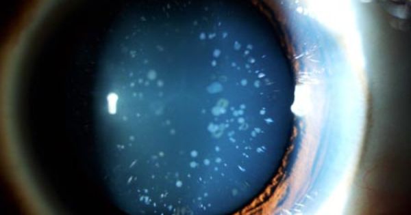 The Blue Dot Cataract: What Causes It and How to Treat It