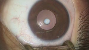 What Is A Developmental Cataract? And Why Do You Need To Get It Treated?