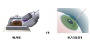 Bladeless Lasik: All About This LASIK Surgery