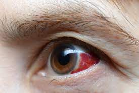 Causes of Traumatic Cataracts