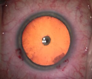 How Can You Treat Posterior Polar Cataracts?