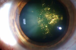 What Is A Christmas Tree Cataract?