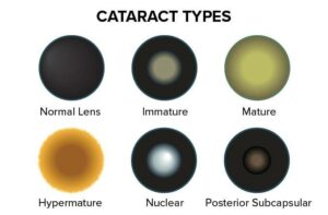 Different Types of Cataracts and What You Need to Know About Them