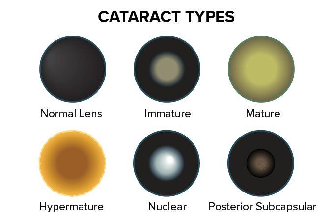 Different Types of Cataracts and What You Need to Know About Them