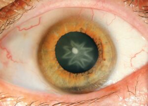 What Is a Spear Shaped Cataract? Treatment Options