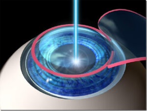 How Much Does Epi LASIK Cost?