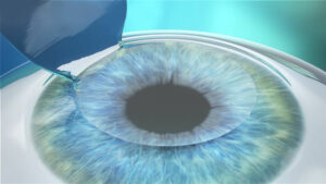 How Much Does FEMTO LASIK Cost?