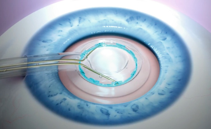 How Zepto Cataract Surgery Can Restore Your Vision