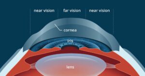 Hyperopic LASIK