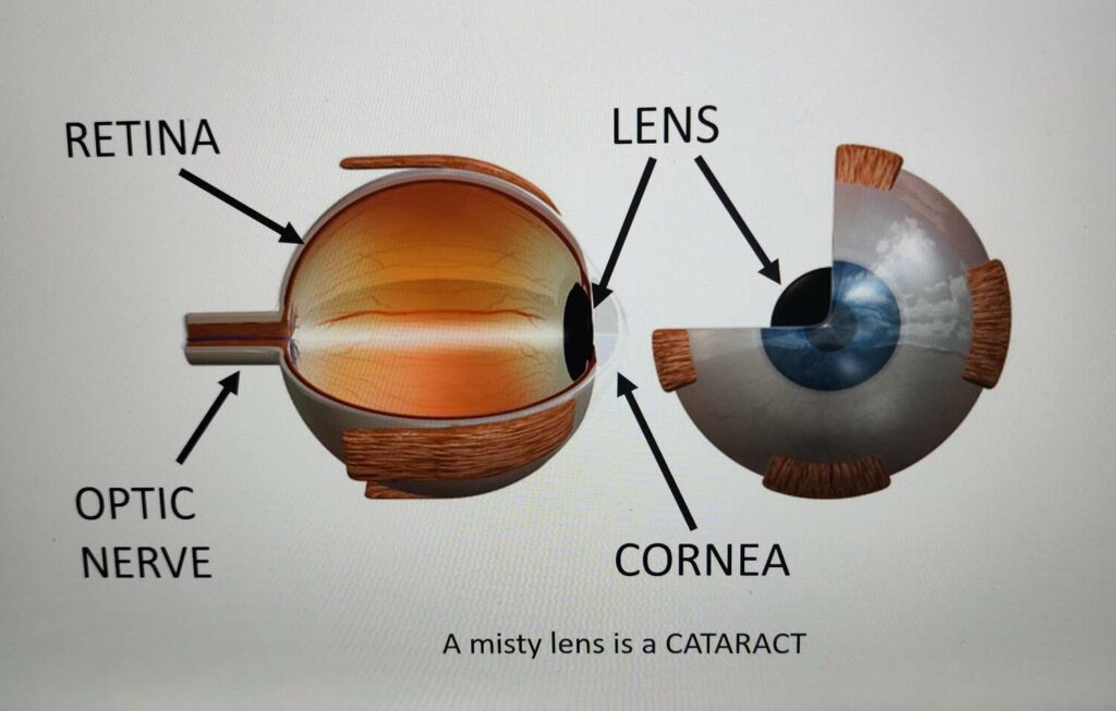 Central Cataract: What It Is and How to Treat It