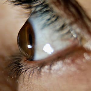Inflammation or distortion of the cornea