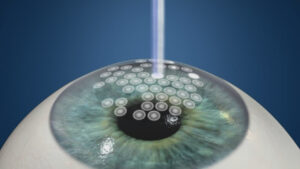 Keratoconus LASIK Detailed Guide on This