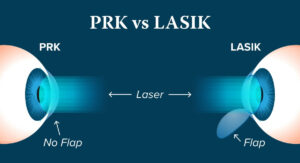 LASIK v/s PRK Eye Treatment