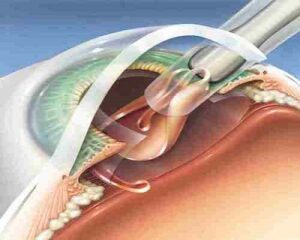 What Is MICS Cataract Surgery?
