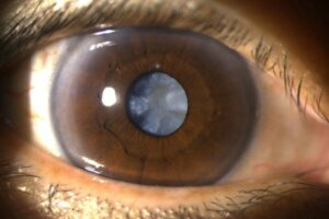 What Is a Dense Cataract?
