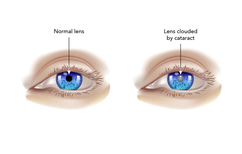 Cuneiform Cataracts: Symptoms, Diagnosis And Prevention