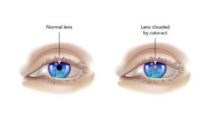 What Is Cupuliform Cataract?