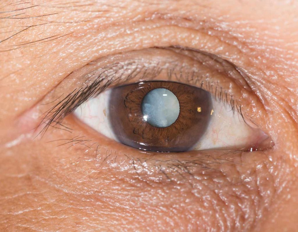 Polychromatic Cataract Detailed Guide on This Cataract