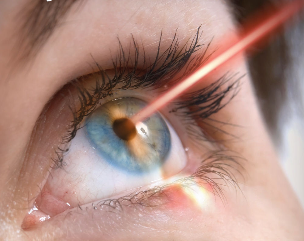 Potential Side Effects of Laser Eye Surgery