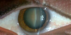 Reasons For Polychromatic Cataracts