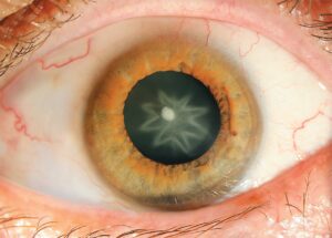 Rosette Catarac All About This Cataract