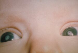 Rubella Cataract Guide About This Rubella Cataract