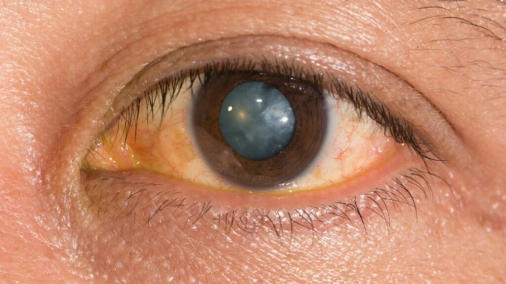 Senile Cataract Signs, Causes and Treatment Options
