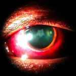Rosette Cataract: Signs, Causes and Treatment