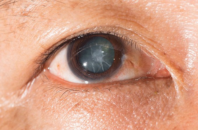 Subluxated Cataract Treating Subluxated Cataract