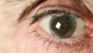 Symptoms of a Right Eye Cataract
