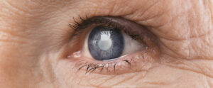 The Truth About Brown Cataracts