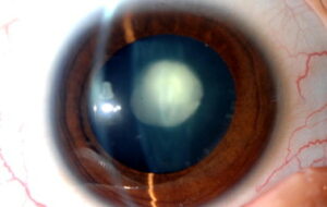 What Is A Posterior Polar Cataract?