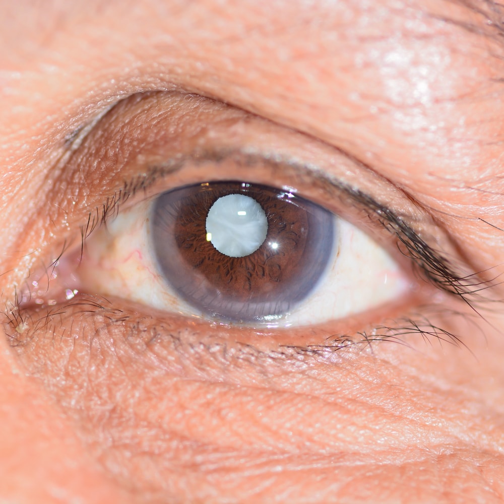 Tramautic Cataracts