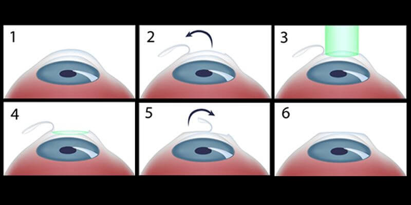 Type of LASIK Different Types of LASIK