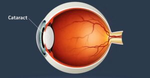 Understanding Cataract