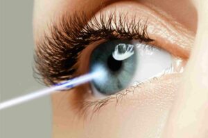 What Is SBK Eye Surgery?